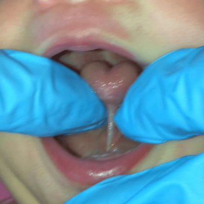 Bayou City Breastfeeding - Tongue Tie Check