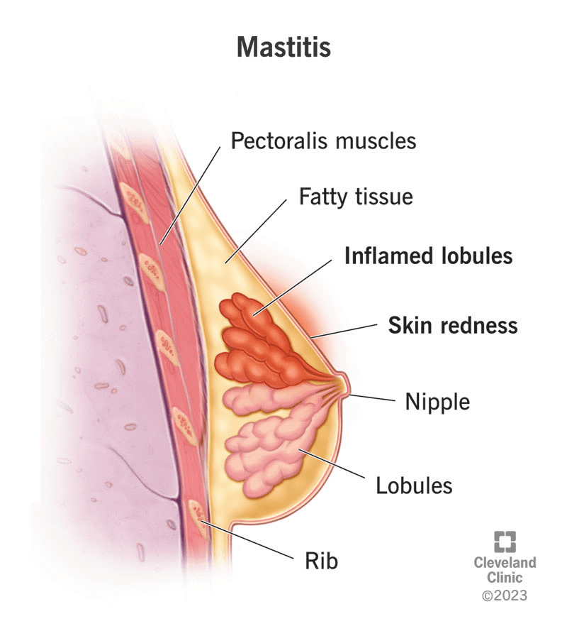 Mastitis