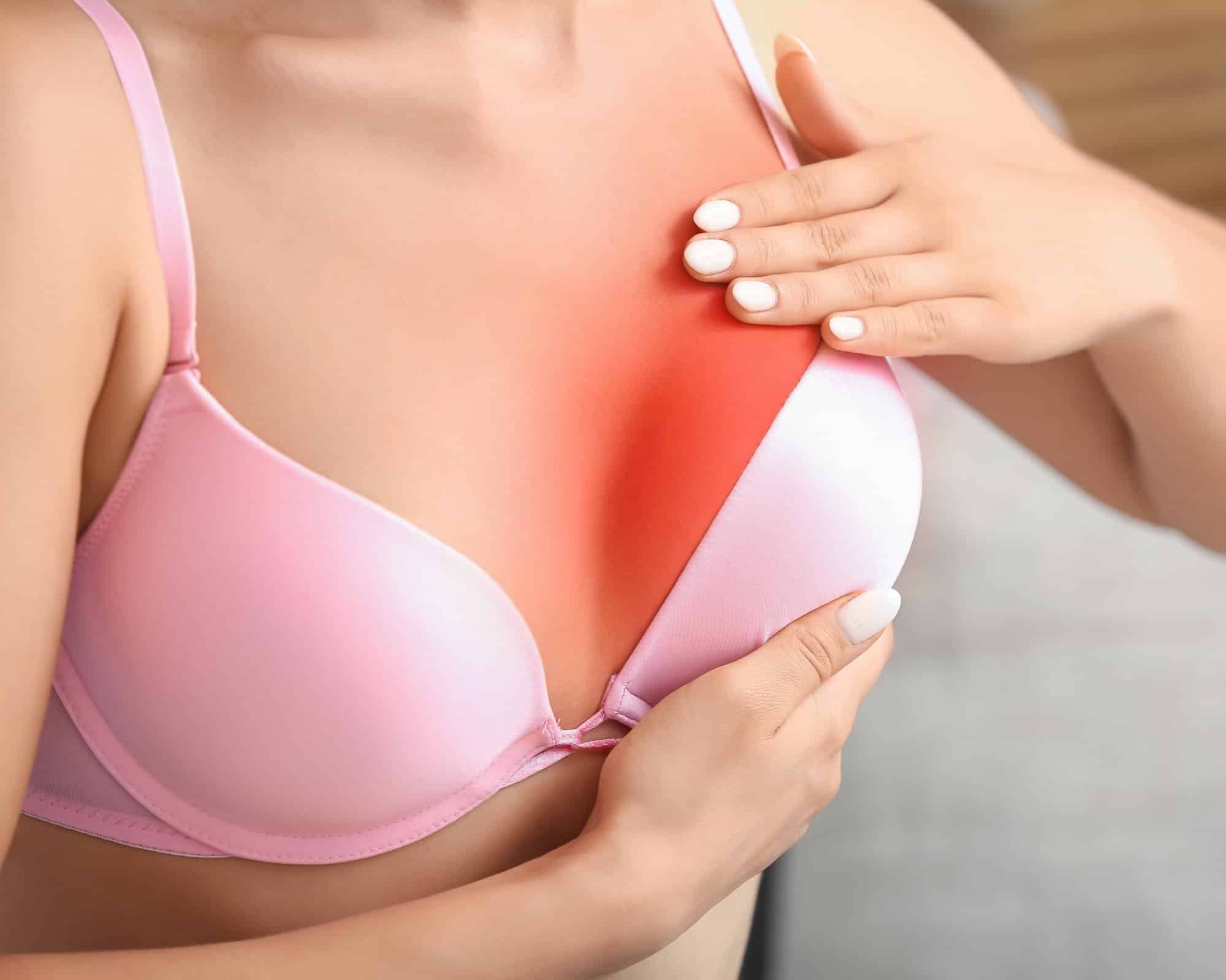 A person in a pink bra resting a hand on the breast, where a red, inflamed area shows the redness and tenderness of mastitis.